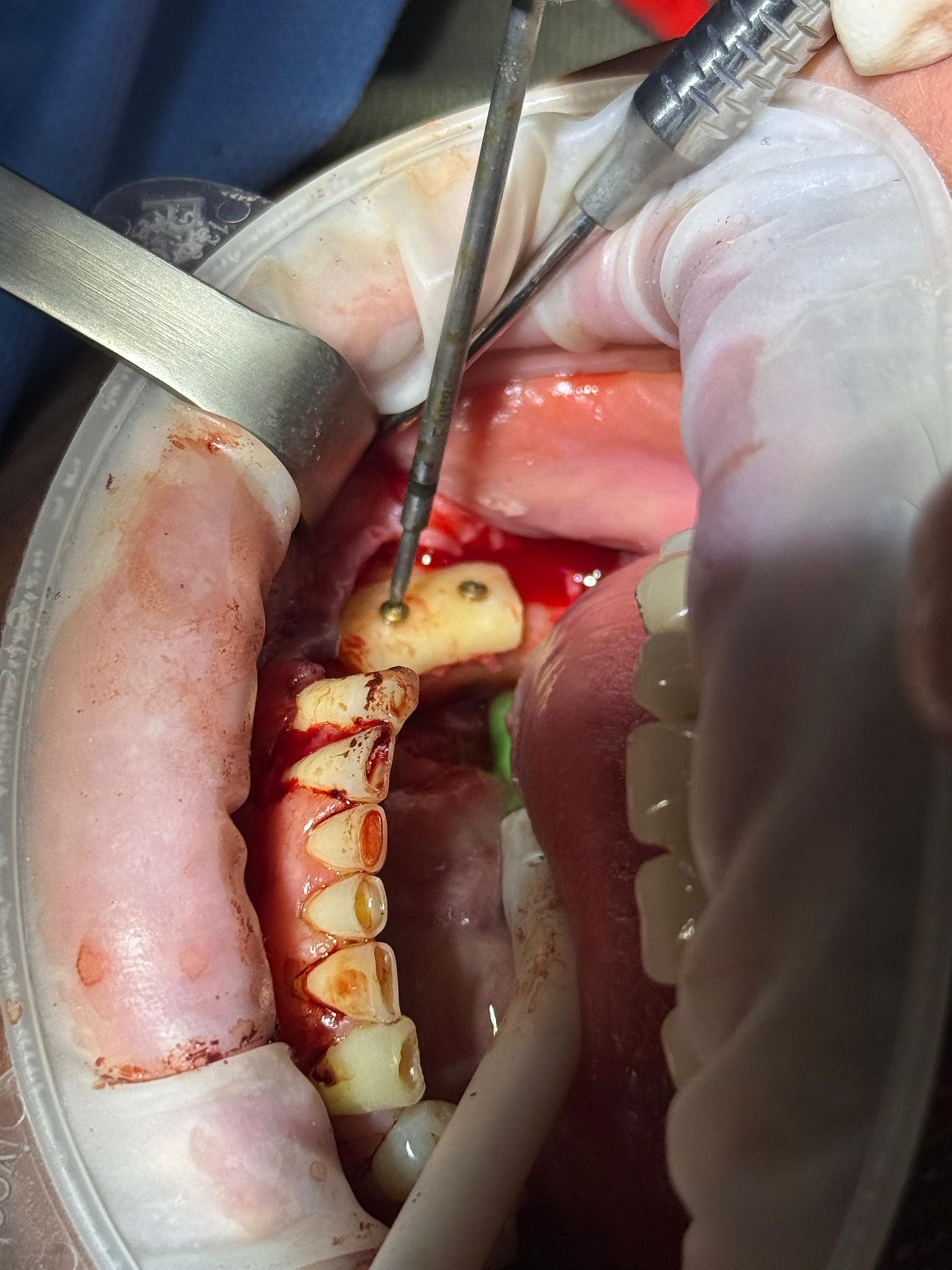 Lucrare implant