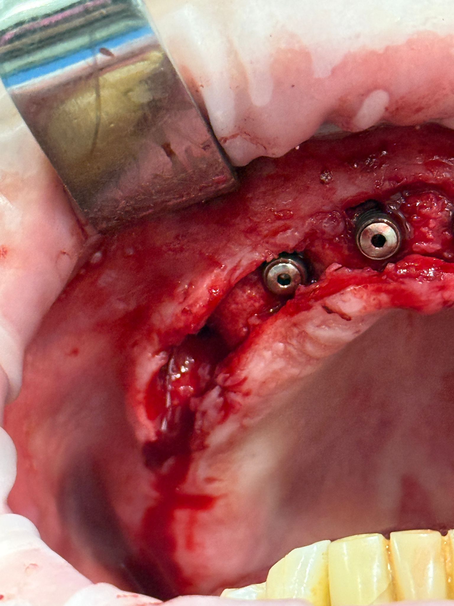 Tratament dentar