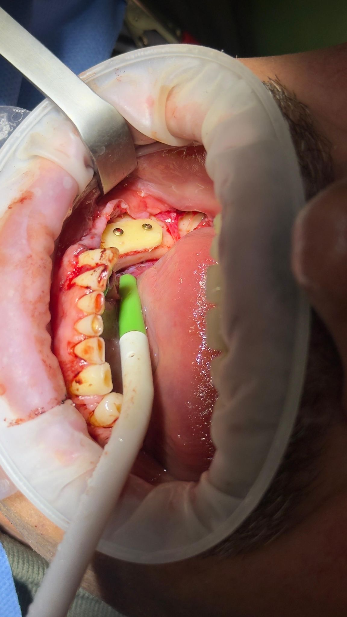 Tratament chirurgical