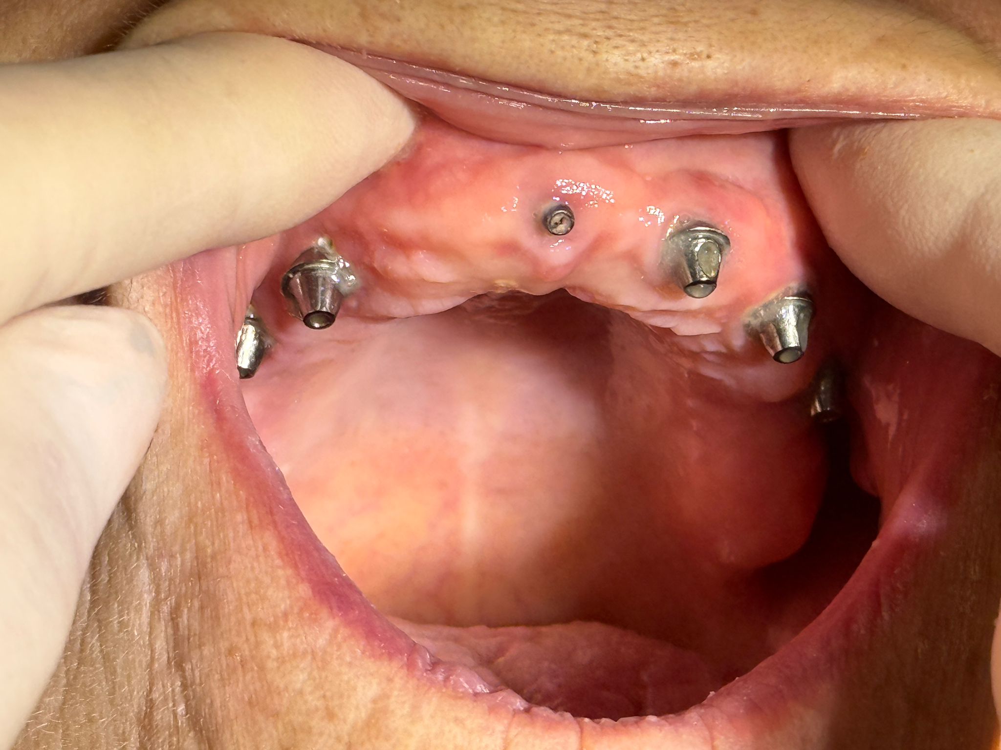 Lucrare implant dentar