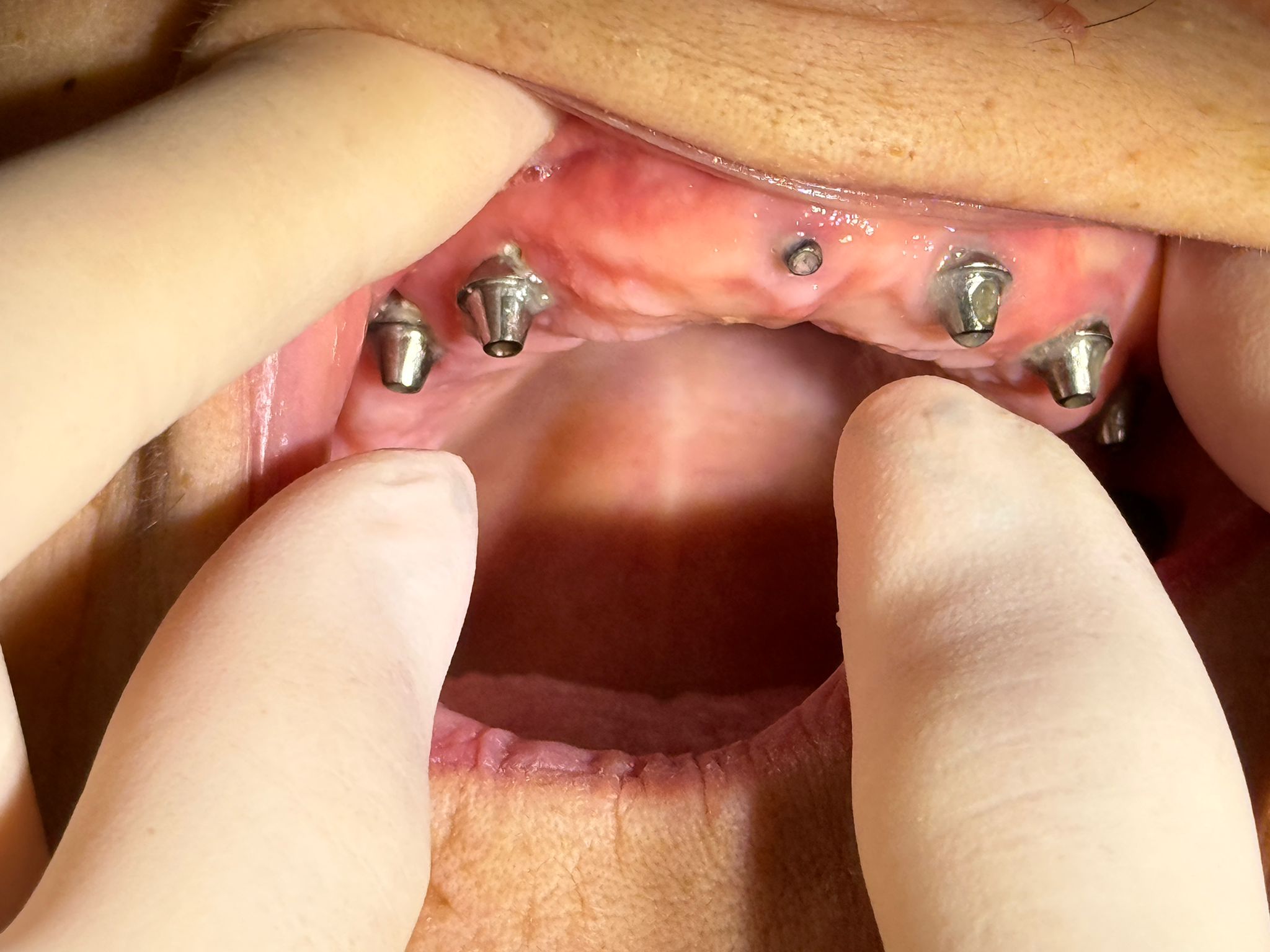 Lucrare implant