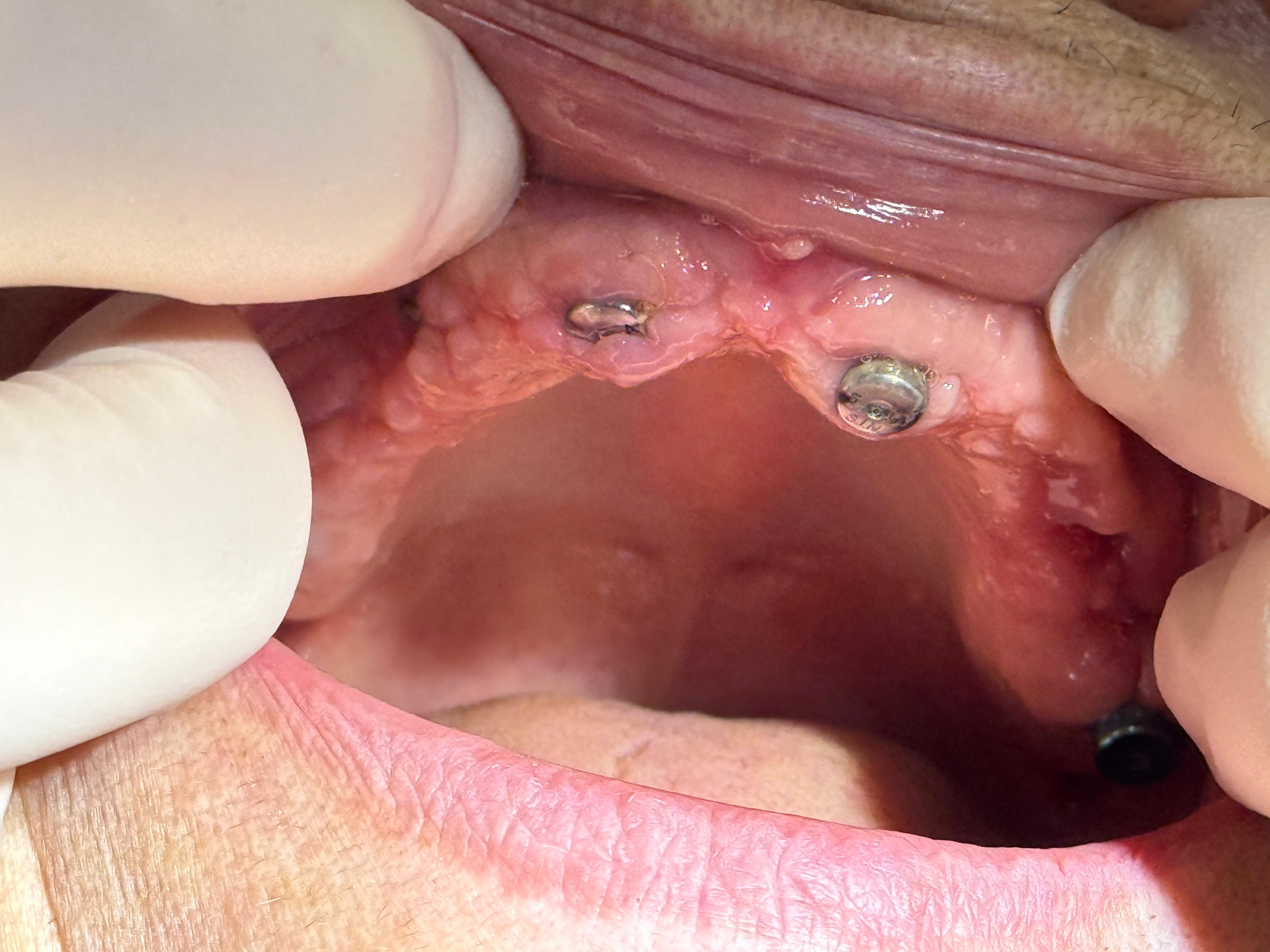Tratament chirurgical