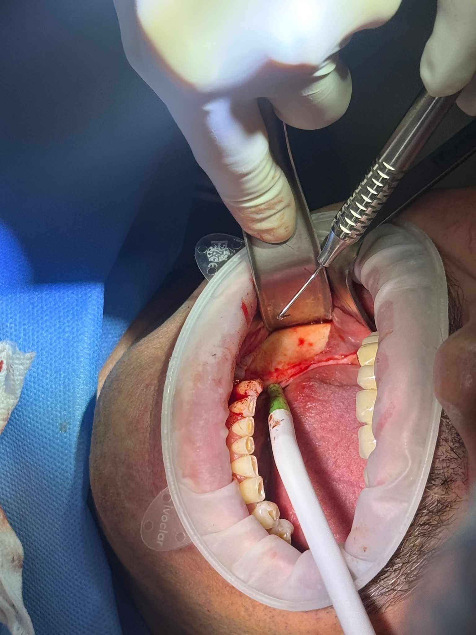 Procedură dentară