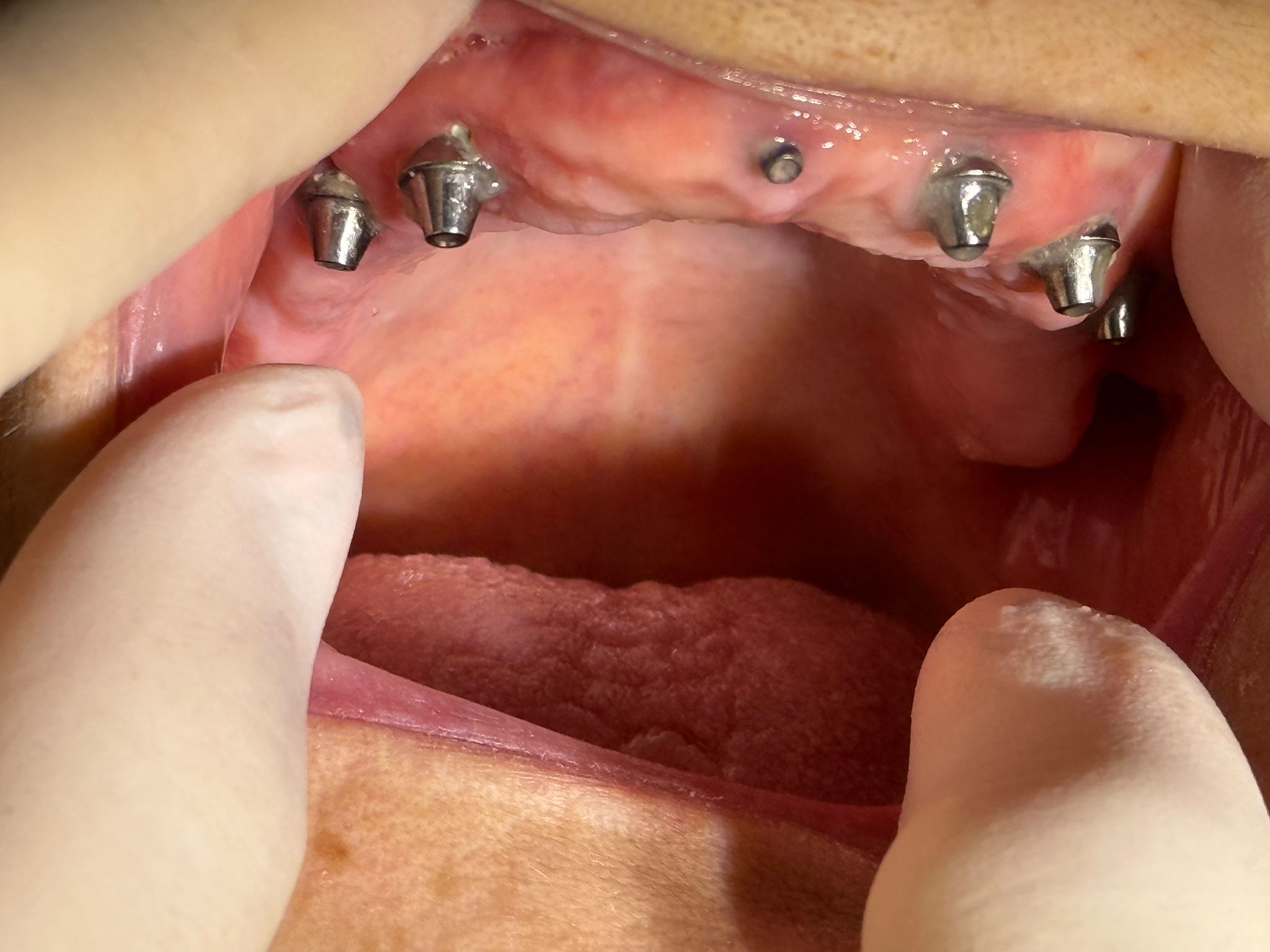 Lucrare implant dentar