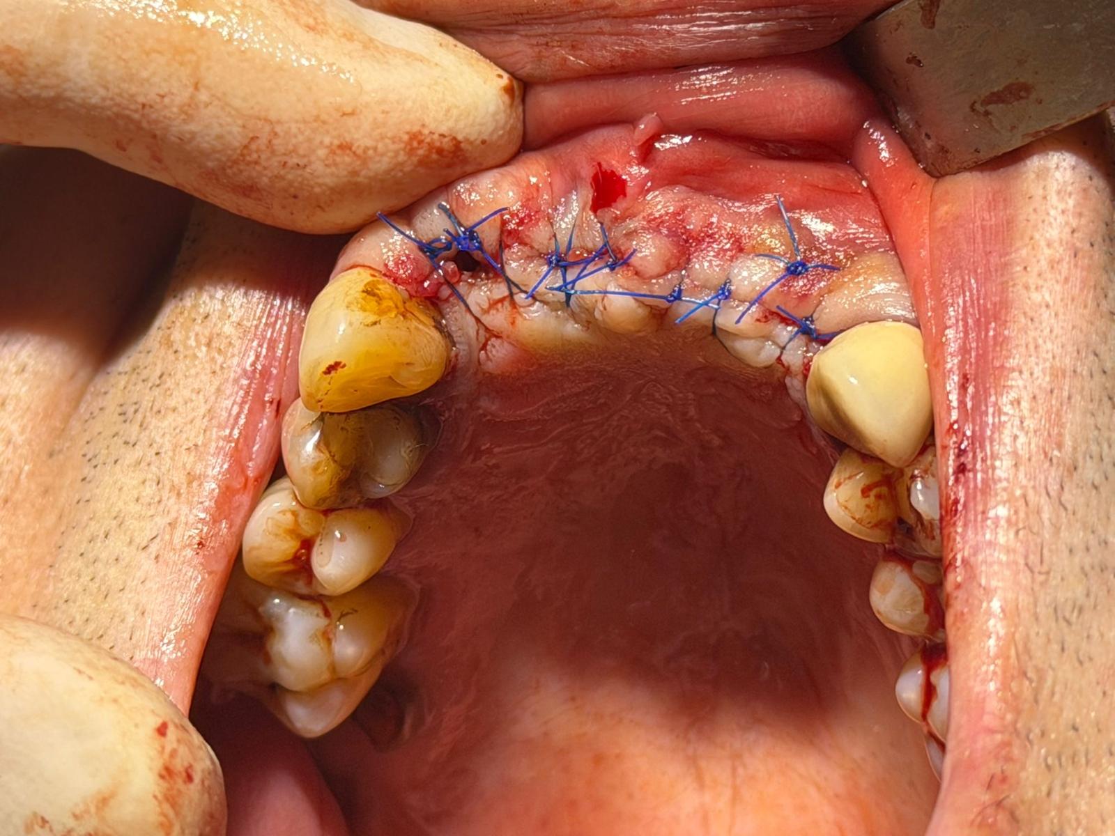 Tratament dentar